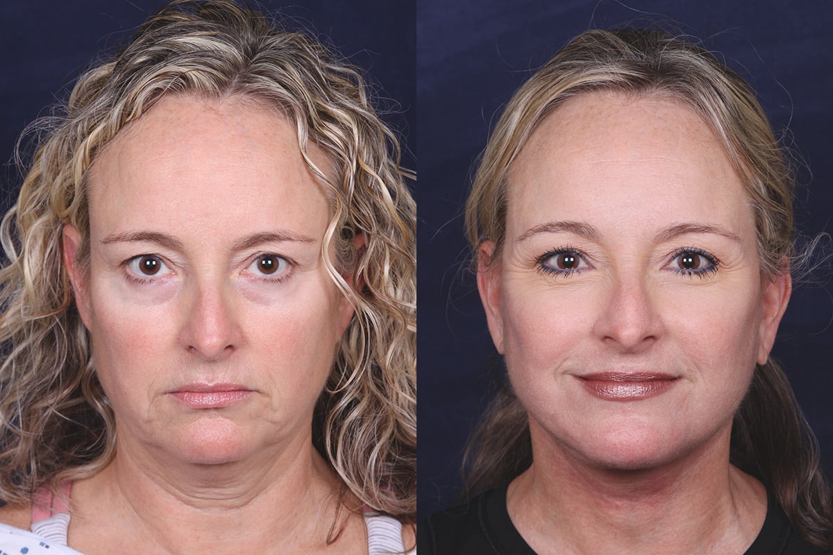 before-after-1