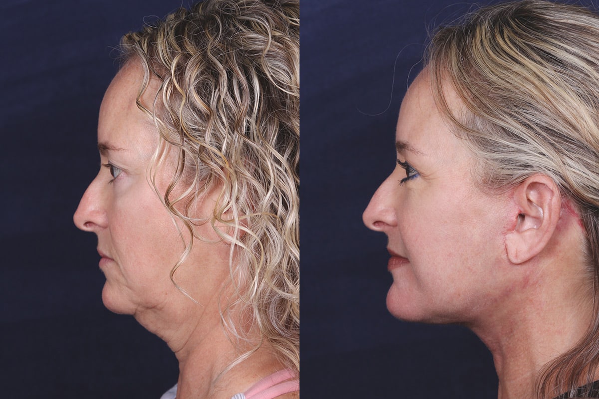 before-after-2