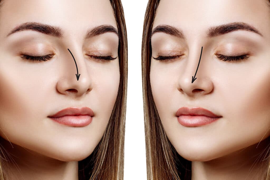 Rhinoplasty in New Jersey 10 Cosmetic rhinoplasty before and after picture.