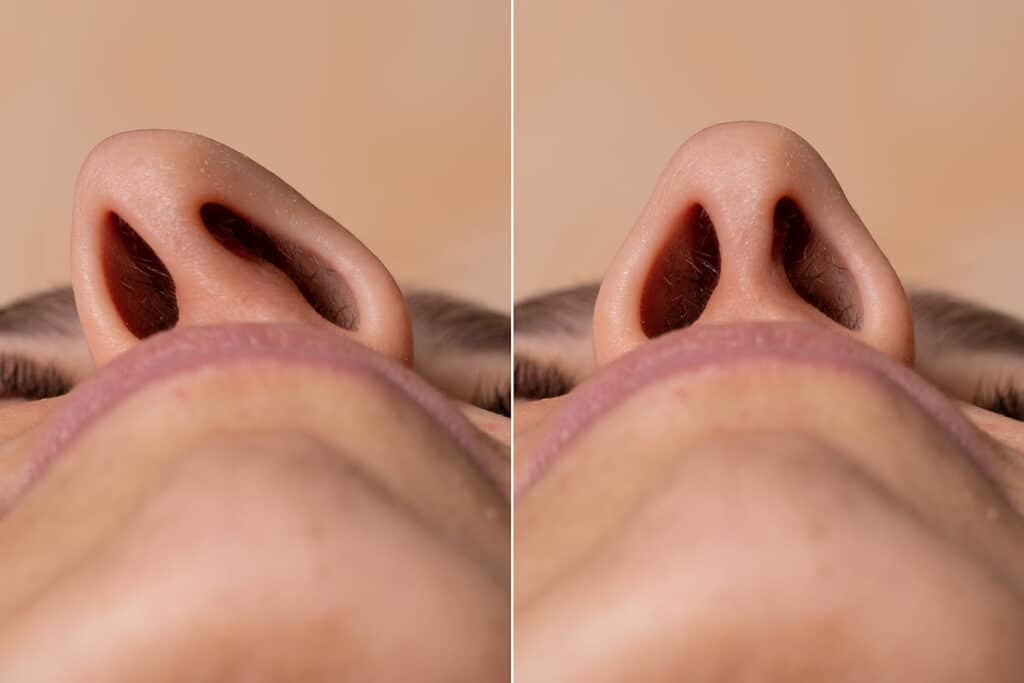 Rhinoplasty in New Jersey 11 functional rhinoplasty