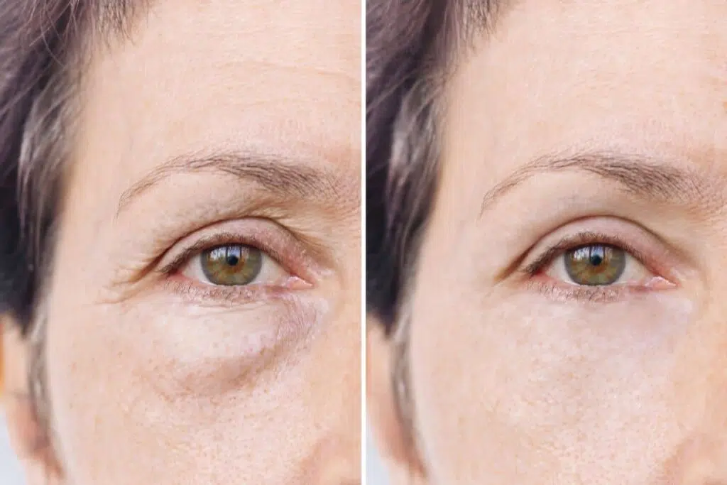 Brighten Tired Eyes: Is Lower Blepharoplasty Effective the Answer to Dark Circles? 2 Side-by-side comparison showing under-eye improvement before and after lower blepharoplasty addressing dark circles.