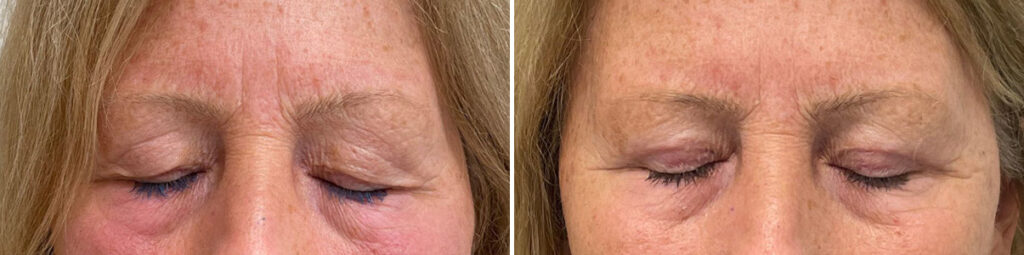 patient-4980-blepharoplasty-before-after