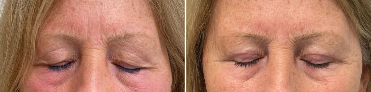 Blepharoplasty Before and After Photos in Monroe Township, NJ, Patient 4980