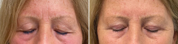 Blepharoplasty Before and After Photos in Monroe Township, NJ, Patient 4980