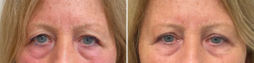 Blepharoplasty Before and After Photos in Monroe Township, NJ, Patient 4980