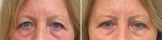 Blepharoplasty Before and After Photos in Freehold, NJ