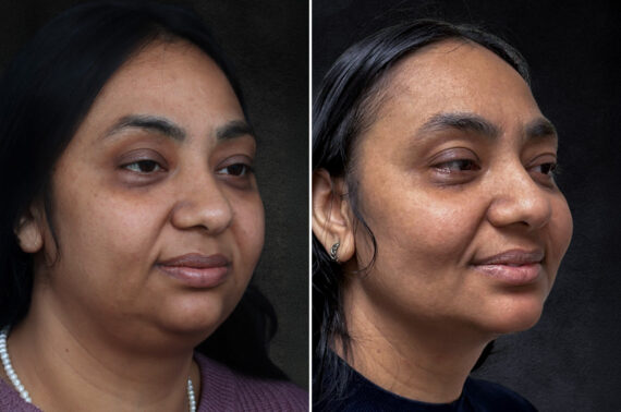 Buccal Fat Removal Before and After Photos in Freehold, NJ, Patient 4987
