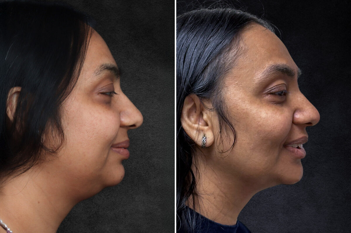 Buccal Fat Removal Before and After Photos in Freehold, NJ, Patient 4987
