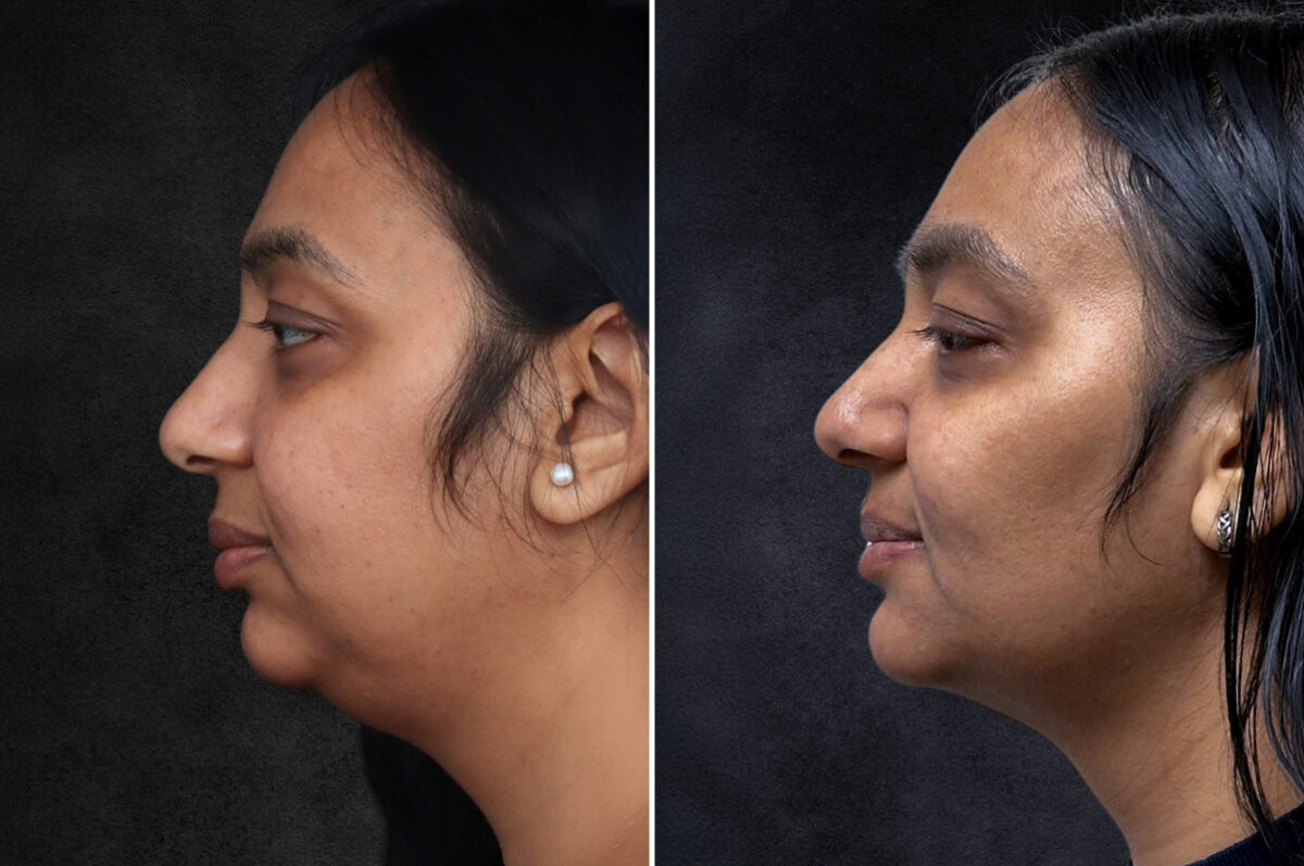 Buccal Fat Removal Before and After Photos in Freehold, NJ, Patient 4987