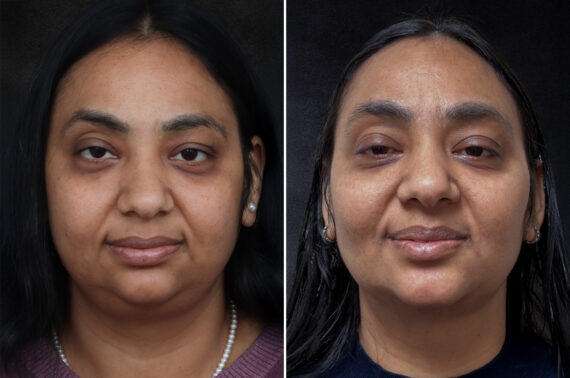 Buccal Fat Removal Before and After Photos in Freehold, NJ, Patient 4987
