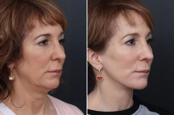 Chin Implants Before and After Photos in Freehold, NJ, Patient 5001