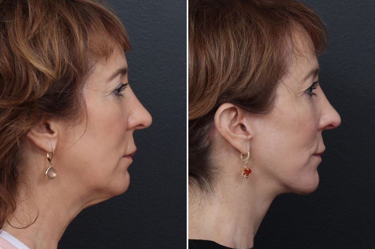 Patient 5001, Chin Implants Before and After Photos Chin Implants Before and After Photos in Freehold, NJ, Patient 5001