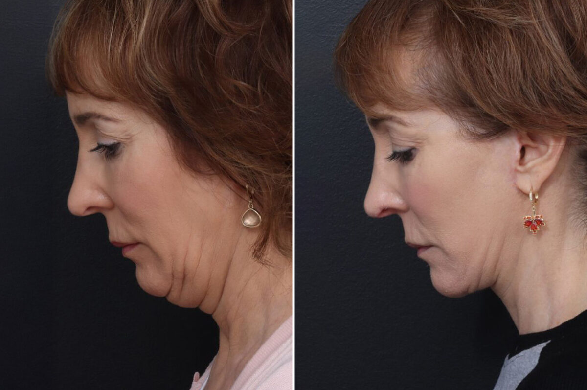 Patient 5001, Chin Implants Before and After Photos Chin Implants Before and After Photos in Freehold, NJ, Patient 5001