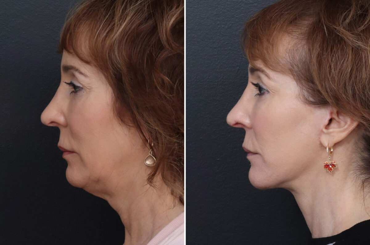 Patient 5001, Chin Implants Before and After Photos Chin Implants Before and After Photos in Freehold, NJ, Patient 5001
