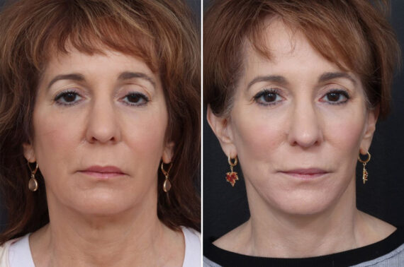 Chin Implants Before and After Photos in Freehold, NJ, Patient 5001