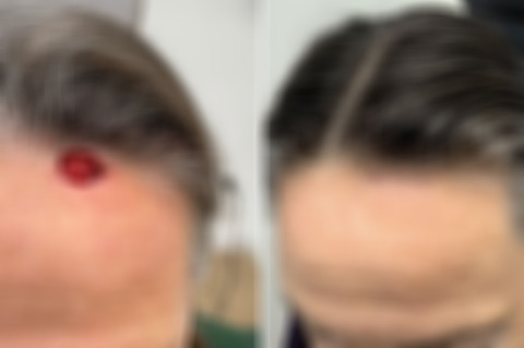 Reconstructive Surgery Before and After Photos in Freehold, NJ, Patient 5032