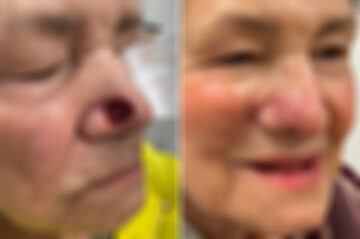 Reconstructive Surgery Before and After Photos in Freehold, NJ, Patient 5060