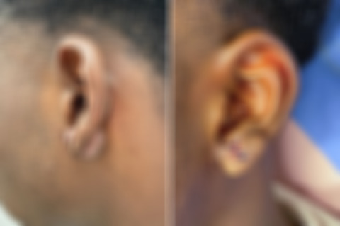 Reconstructive Surgery Before and After Photos in Freehold, NJ, Patient 5075