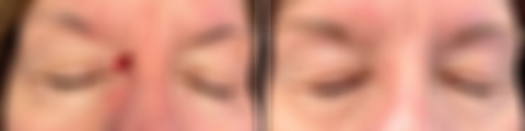 Reconstructive Surgery Before and After Photos in Freehold, NJ, Patient 5082