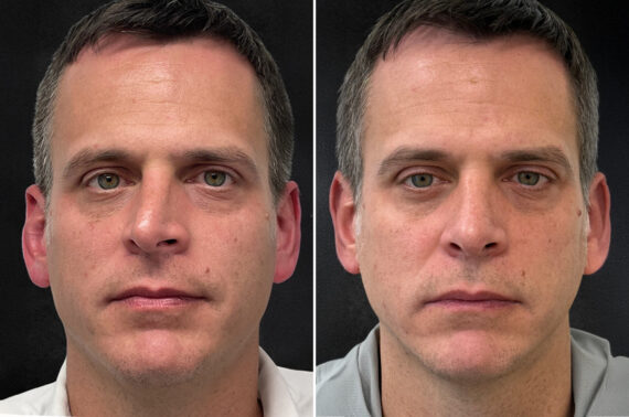 Rhinoplasty Before and After Photos in Freehold, NJ