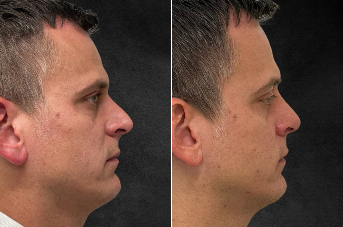Rhinoplasty Before and After Photos in Freehold, NJ, Patient 5089