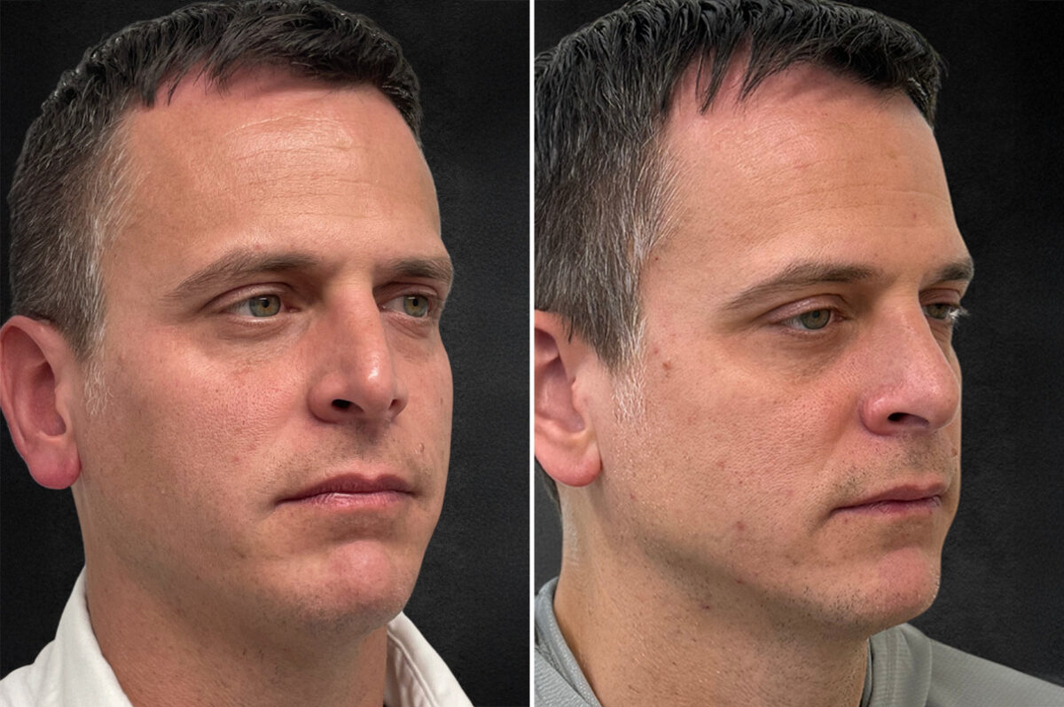 Rhinoplasty Before and After Photos in Freehold, NJ, Patient 5089