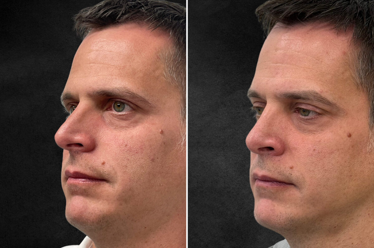 Rhinoplasty Before and After Photos in Freehold, NJ, Patient 5089