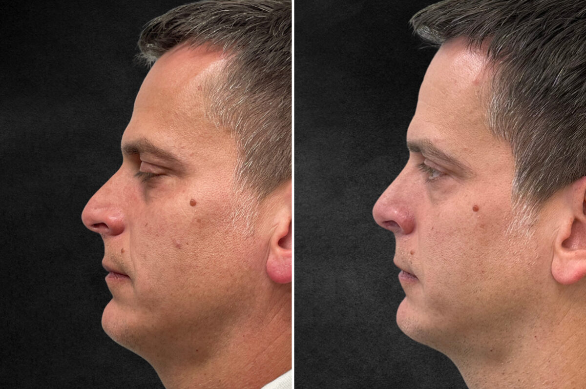 Rhinoplasty Before and After Photos in Freehold, NJ, Patient 5089