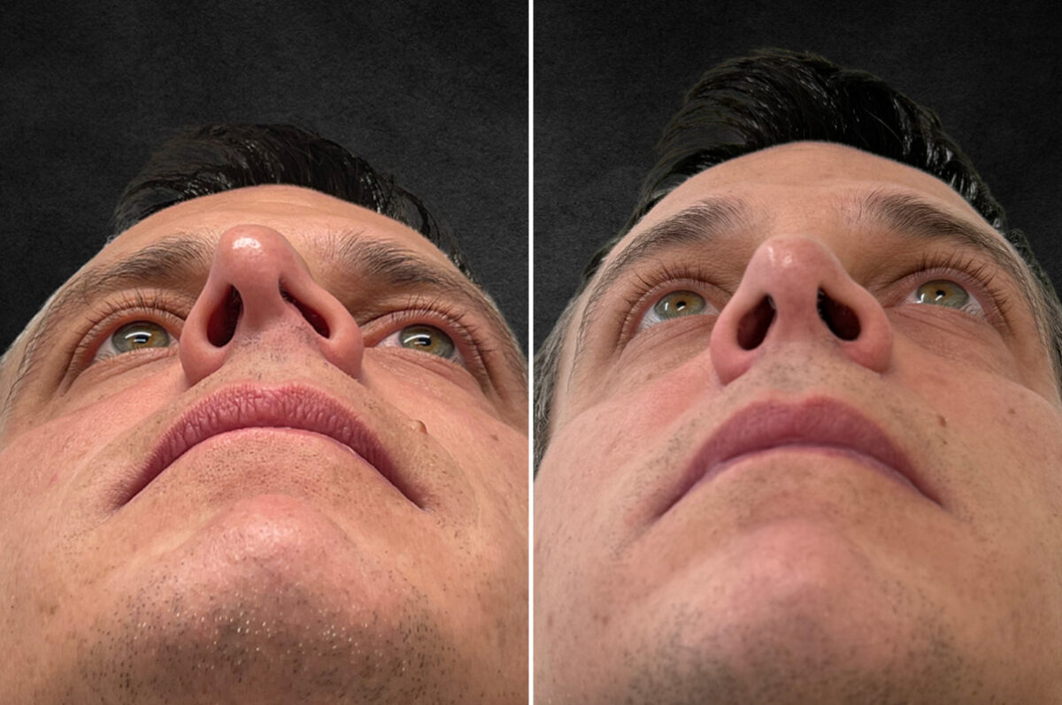 Rhinoplasty Before and After Photos in Freehold, NJ, Patient 5089