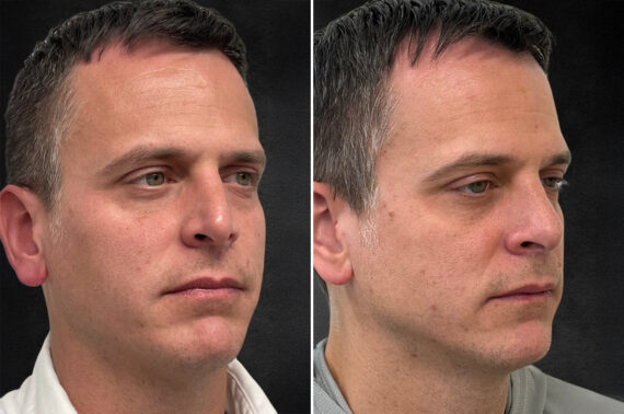 Rhinoplasty Before and After Photos in Freehold, NJ, Patient 5089