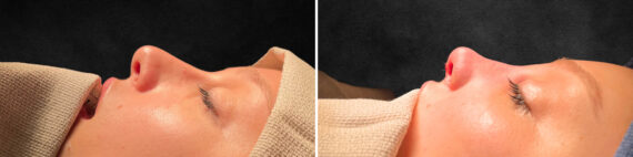 Rhinoplasty Before and After Photos in Freehold, NJ, Patient 5108