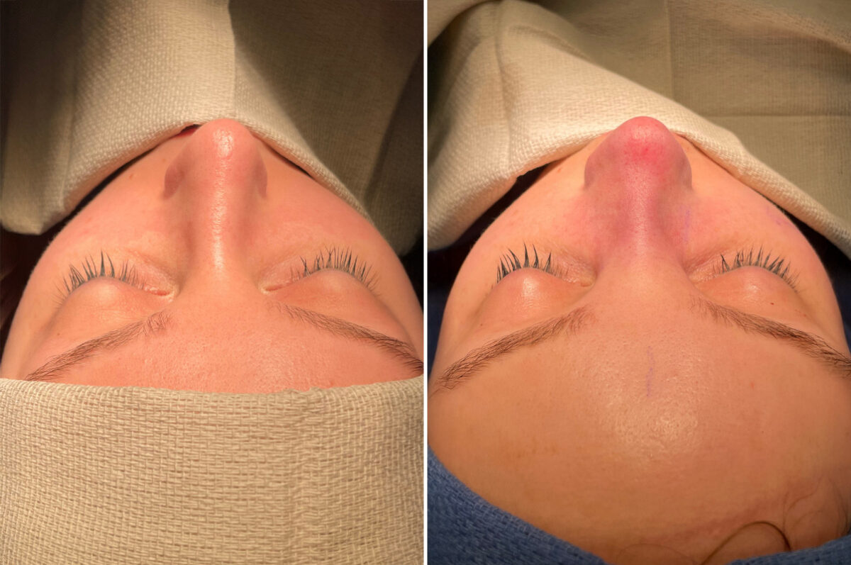 Patient 5108, Rhinoplasty Before and After Photos Rhinoplasty Before and After Photos in Freehold, NJ, Patient 5108