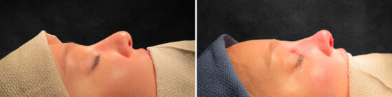 Rhinoplasty Before and After Photos in Freehold, NJ