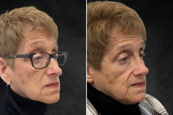Rhinoplasty Before and After Photos in Freehold, NJ, Patient 5118