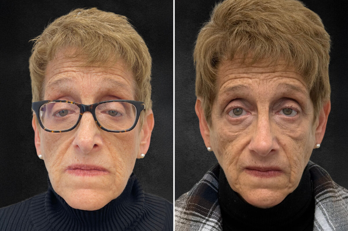 Rhinoplasty Before and After Photos in Freehold, NJ, Patient 5118