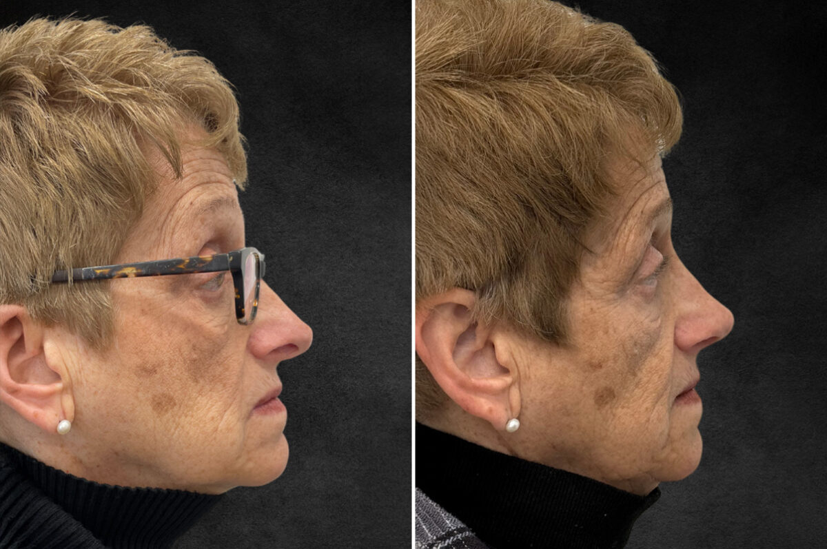 Rhinoplasty Before and After Photos in Freehold, NJ, Patient 5118
