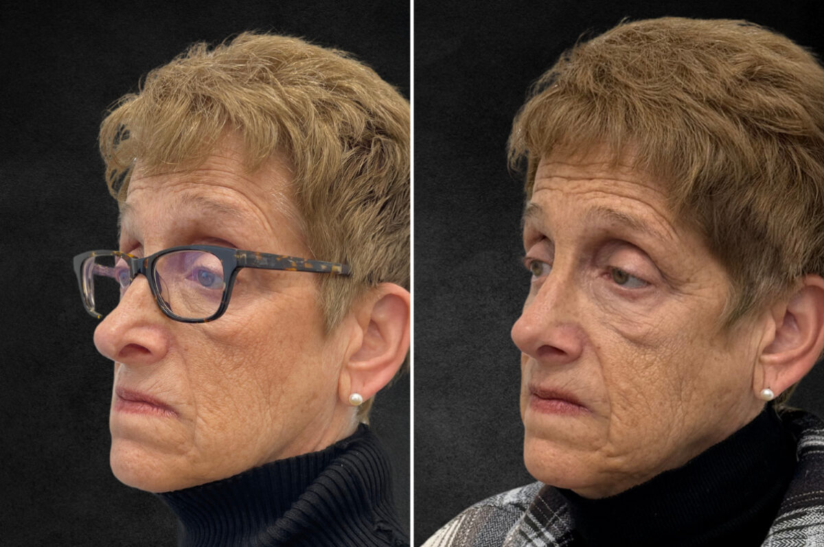 Rhinoplasty Before and After Photos in Freehold, NJ, Patient 5118
