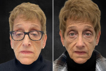 Rhinoplasty Before and After Photos in Freehold, NJ, Patient 5118