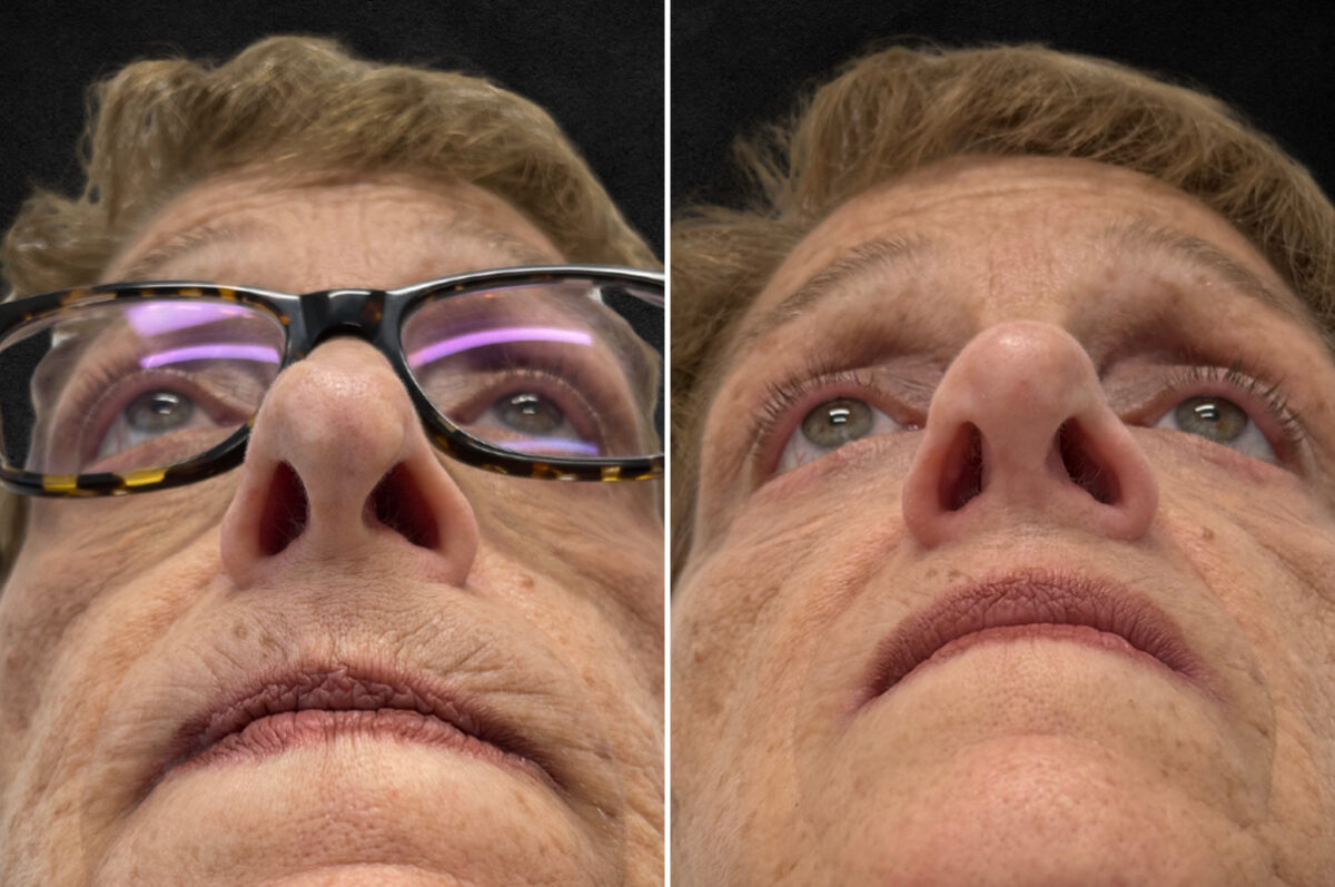 Rhinoplasty Before and After Photos in Freehold, NJ, Patient 5118