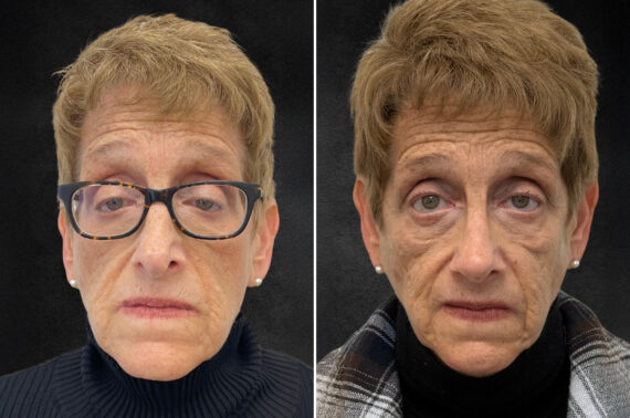 Rhinoplasty Before and After Photos in Freehold, NJ, Patient 5118