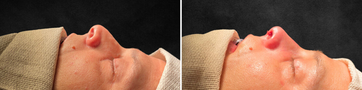 Patient 5137, Rhinoplasty Before and After Photos Rhinoplasty Before and After Photos in Freehold, NJ, Patient 5137
