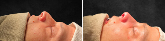 Rhinoplasty Before and After Photos in Freehold, NJ, Patient 5137
