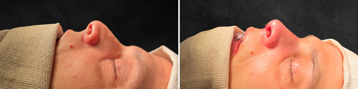 Patient 5137, Rhinoplasty Before and After Photos Rhinoplasty Before and After Photos in Freehold, NJ, Patient 5137