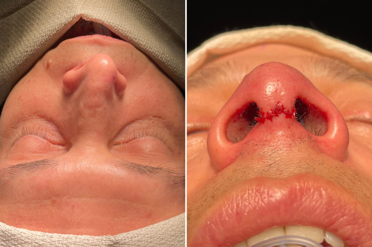 Patient 5137, Rhinoplasty Before and After Photos Rhinoplasty Before and After Photos in Freehold, NJ, Patient 5137
