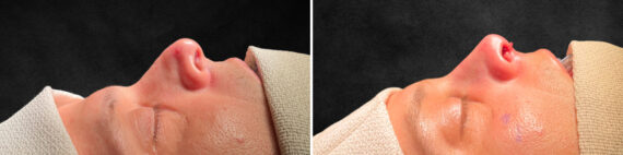 Rhinoplasty Before and After Photos in Freehold, NJ, Patient 5137