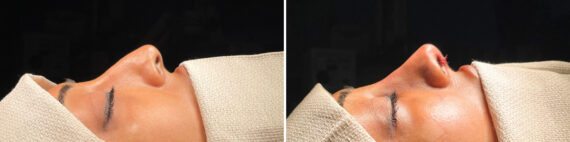 Rhinoplasty Before and After Photos in Freehold, NJ, Patient 5153