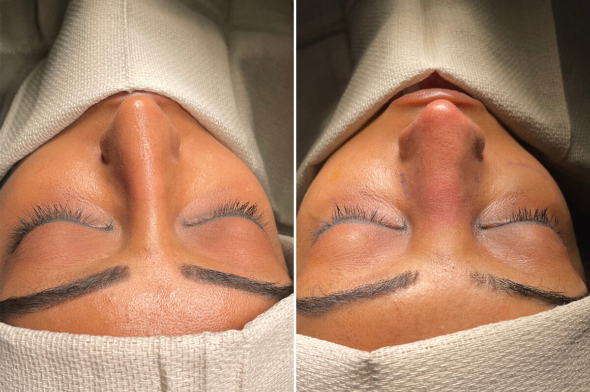 Patient 5153, Rhinoplasty Before and After Photos Rhinoplasty Before and After Photos in Freehold, NJ, Patient 5153