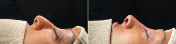 Rhinoplasty Before and After Photos in Freehold, NJ, Patient 5153