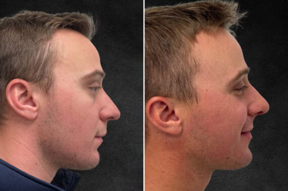 Rhinoplasty Before and After Photos in Freehold, NJ, Patient 5163