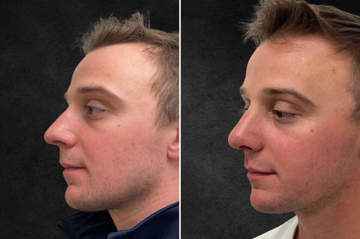 Patient 5163, Rhinoplasty Before and After Photos Rhinoplasty Before and After Photos in Freehold, NJ, Patient 5163